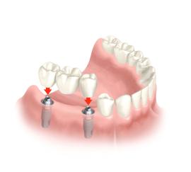 Ein Implantat samt Brücke wird gesetzt